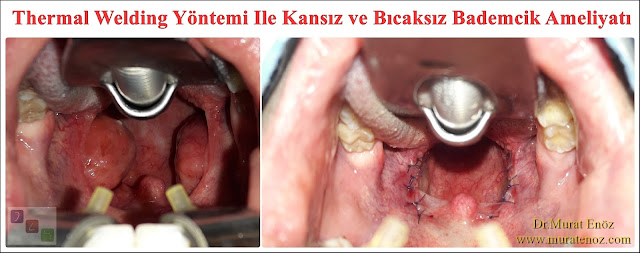 Before and After Potos For Thermal Welding Tonsillectomy Operation