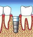 que es un implante dental 2022