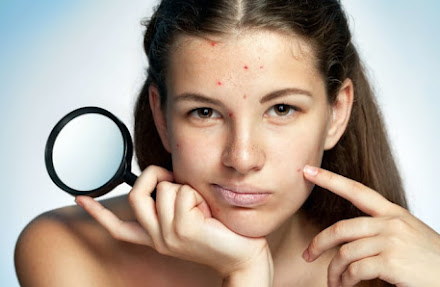  Por que algumas pessoas com acne sofrem mais com inflamação do que outras? Descubra o que fazer