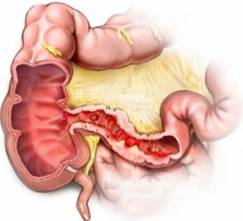 Crohn's Disease Causes-Symptoms And Treatment | crohn's disease pictures