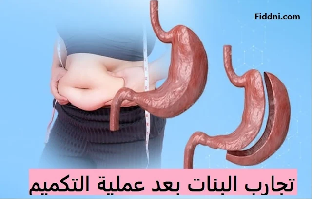 تجارب البنات بعد عملية التكميم