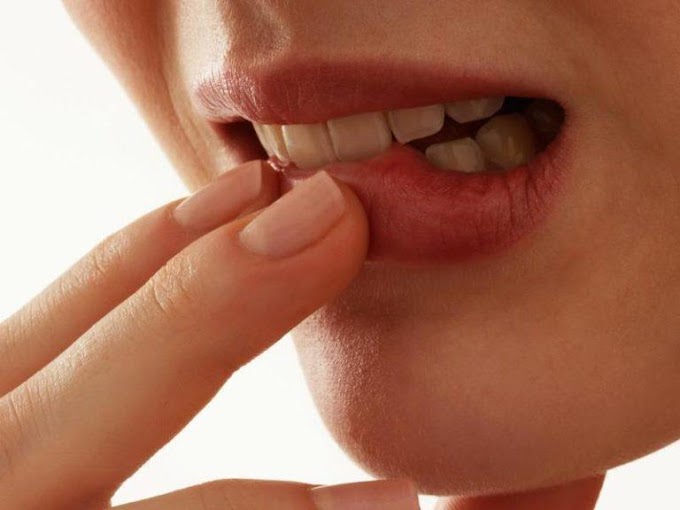    Cure Mouth Ulcer In One Day منہ کے چھالے دور کرنے کیلئے