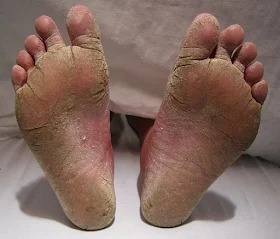 Tinea Pedis- Explained