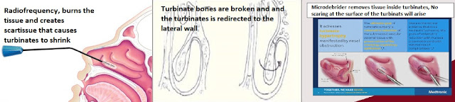 Methods for turbinoplasty