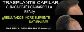 trasplante pelo Clínica Estética  implante capilar para mujeres  o para hombres or en Marbella y Málaga: Te proponemos la alta calidad de servicios con los mejores 