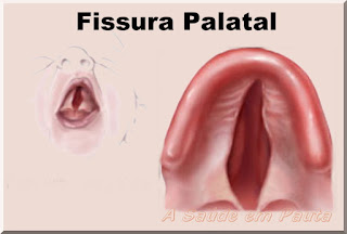 Fenda palatina ou fissura palatal