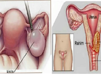 Hati - hati Untuk Para Wanita Haid Jangan Melakukan Hal Ini Jika Tidak Ingin Terkena KISTA dan KANKER RAHIM