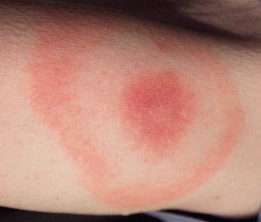 Symptoms And Treatment Of Lyme Disease