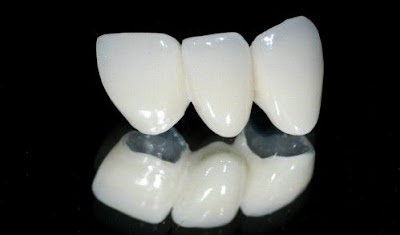  Bọc răng sứ Zirconia ở đâu tốt?