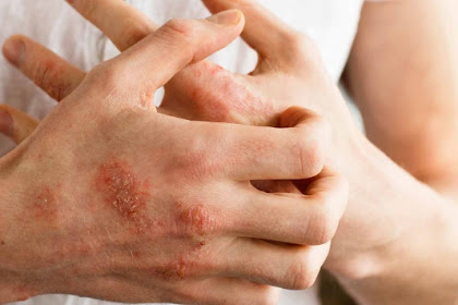 THE MEDICINAL FRUIT THAT TREATS ECZEMA & PSORIASIS