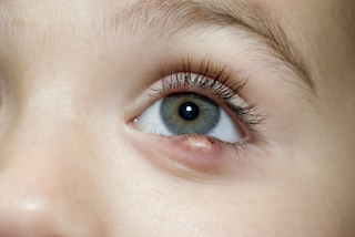 Styes treatments, diagnosis and symptoms in children and adolescents