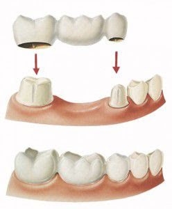 Thời gian làm cầu răng sứ