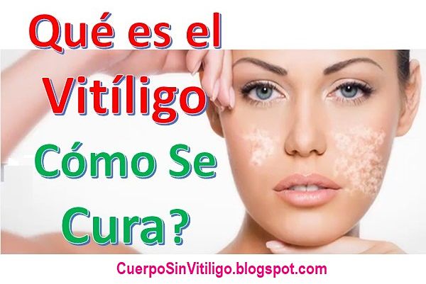 que-es-el-vitiligo-como-se-cura-causas-sintomas-tratamientos
