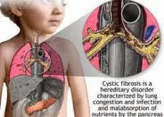 Cystic Fibrosis