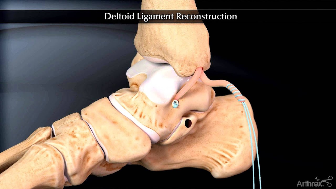 Deltoid Ligament Injury