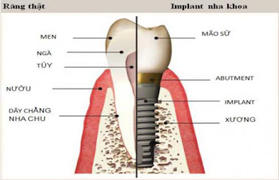 trong-rang-gia-implant