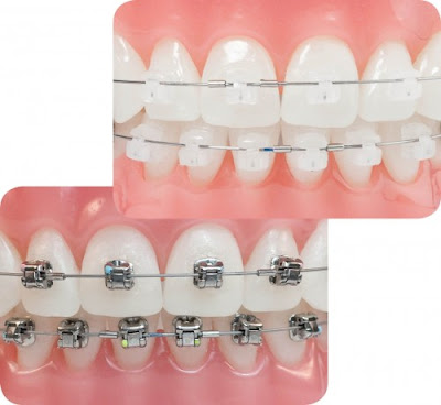 Các loại mắc cài niềng răng phổ biến mắc cài sứ và mắc cài kim loại