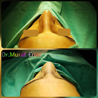 Nasal valve collapse,Alar collapse,Septorhinoplasty in istanbul,Rhinoplasty in men Turkey,