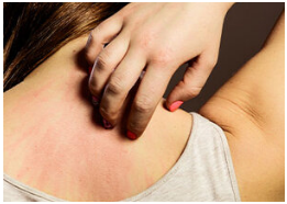 Natural Treatment for Rashes