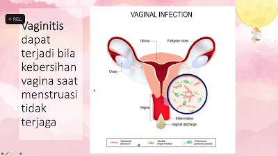 Vaginal Infection