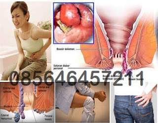 Gambar Obat Herbal Untuk Penyakit Wasir (Hemoroid)