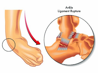 studi kasus sprain ankle yang menyerang atlit dan umum