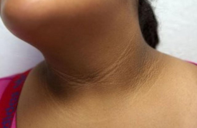 What do you need to know about acanthosis nigricans?