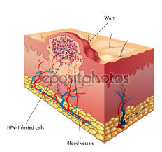 Virus Kutil Kelamin