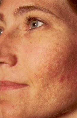 melasma