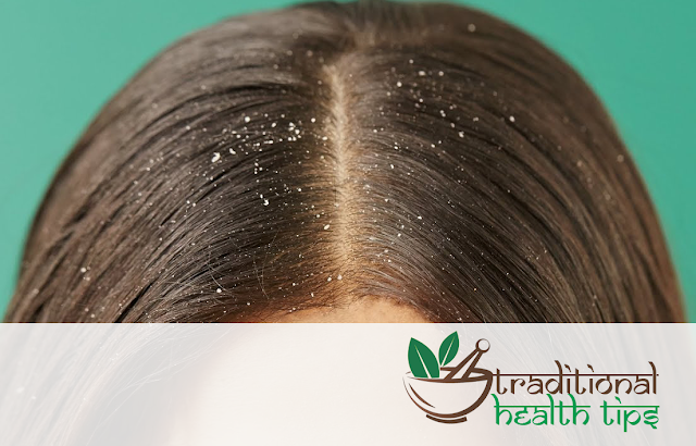 Home Remedies and Ayurvedic Treatment for Hair Dandruff