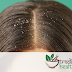 Home Remedies and Ayurvedic Treatment for Hair Dandruff