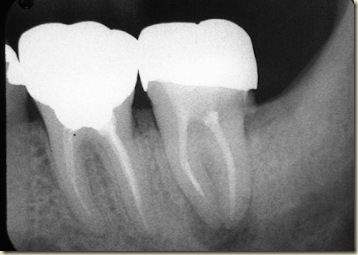 Separated Instrument preop2