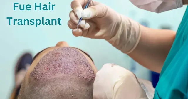 fue hair transplant kya hai kaise kiya jata hai evam kitna kharch ata hai