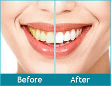 teeth bleaching