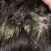 How To Remove Natural Dandruff Fast