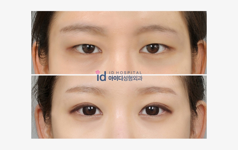 ID Hospital Korea  FAQ Eyelid Surgery Everything you need 