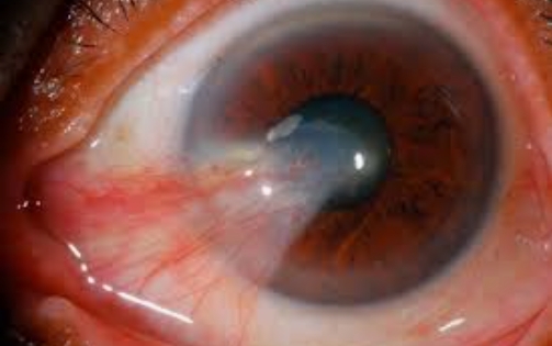 Pterygium