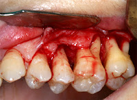 cirugia tratamiento periodontitis piorrea