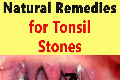 Natural Remedies for Tonsil Stones