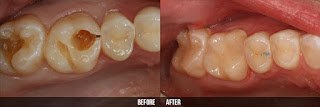 Nguyên nhân gây sâu răng hàm là gì?