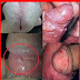 Lepuhan di Alat Vital Akibat Herpes