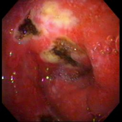 Peptic Ulcer Disease. Peptic+ulcer+disease+