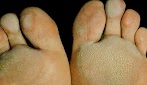 Cara Menghilangkan Kaki Rayapan