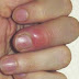 Paronychia Nail infection Herble Treatment At Home