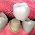 Làm răng sứ sử dụng được bao lâu?