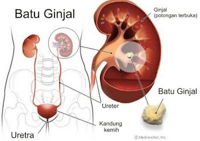 Kelainan dan Penyakit pada Ginjal