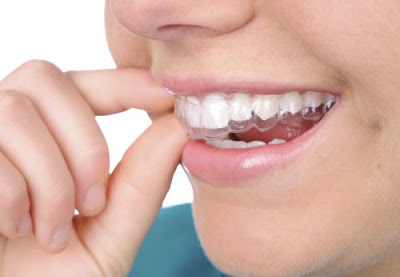 Niềng răng không nhổ răng cho trẻ em