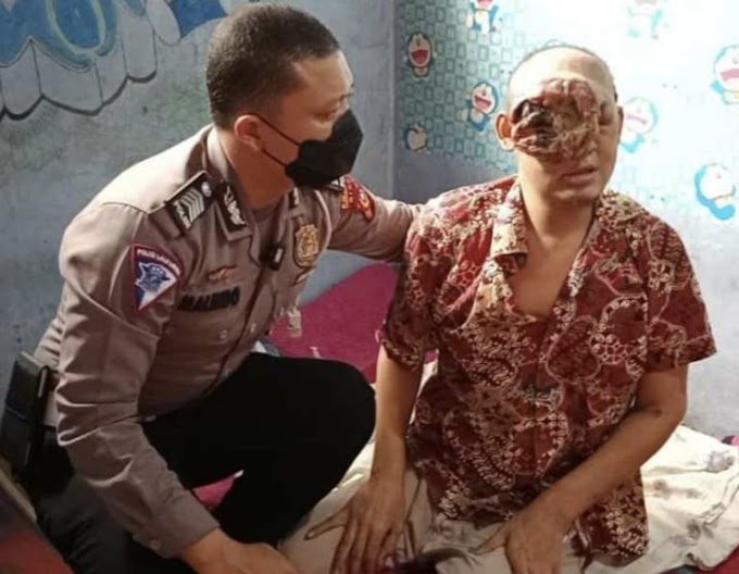 Arianto Mengidap Penyakit Tumor Ganas Dimata, Polisi Bantu Carikan Pendonasi 