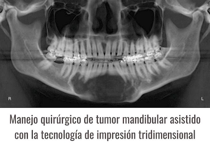 CASO CLÍNICO: Manejo quirúrgico de tumor mandibular asistido con la tecnología de impresión tridimensional