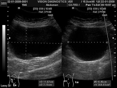 ovarian cysts